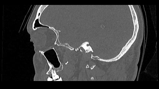 Arcuate foramen (Radiopaedia 89833-106944 Sagittal bone window 113).jpg