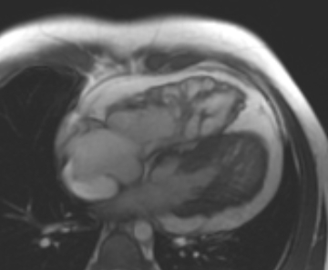 File:Arrhythmogenic right ventricular cardiomyopathy (Radiopaedia 69431-79307 4ch cine 11).jpg