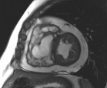 Arrhythmogenic right ventricular cardiomyopathy (Radiopaedia 69431-79307 Short axis cine 111).jpg