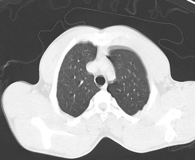 Arrow injury to the chest (Radiopaedia 75223-86321 Axial lung window 5).jpg