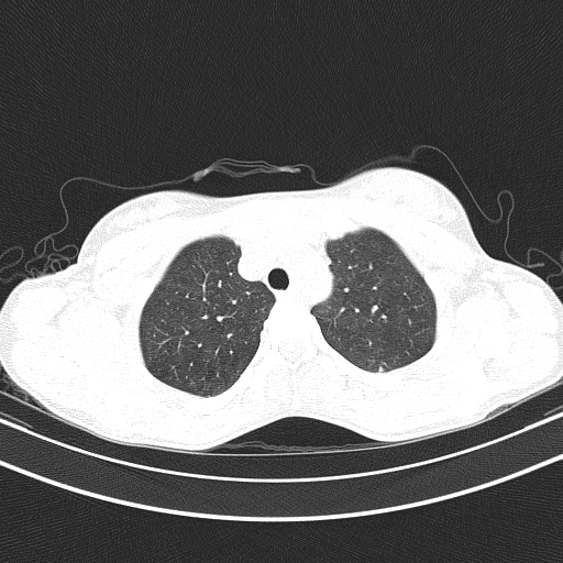 Arteria lusoria (Radiopaedia 88528-105192 Axial lung window 17).jpg