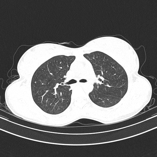 Arteria lusoria (Radiopaedia 88528-105192 Axial lung window 25).jpg