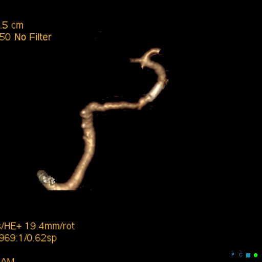File:Artifactual basilar artery stenosis due to metallic stent (Radiopaedia 31206-31923 C 8).jpg