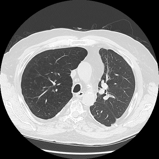 Asbestos-related pleural disease (Radiopaedia 74366-85250 Axial lung window 42).jpg