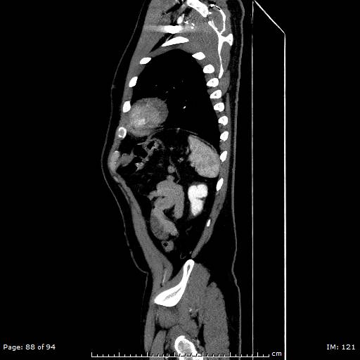 Ascending aortic aneurysm (Radiopaedia 50086-55404 C 62).jpg
