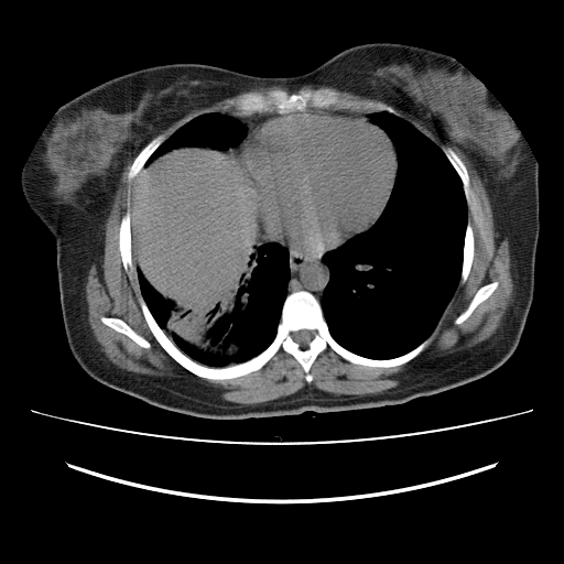 File:Ascending retrocecal appendicitis with liver abscesses (Radiopaedia 60066-67615 Axial non-contrast 3).jpg