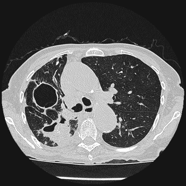 Aspergilloma (Radiopaedia 24458-24763 Axial lung window 24).jpg