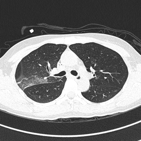 Aspergilloma (Radiopaedia 26223-26347 Axial lung window 30).jpg