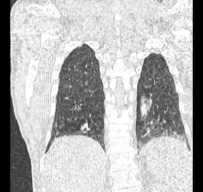 Aspergilloma (Radiopaedia 44592-48327 Coronal lung window 107).jpg