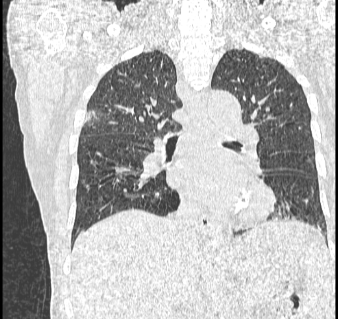 Aspergilloma (Radiopaedia 44592-48327 Coronal lung window 73).jpg