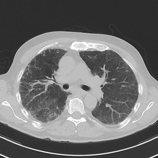 Aspergilloma on background pulmonary fibrosis (Radiopaedia 60942-68757 A 25).jpg
