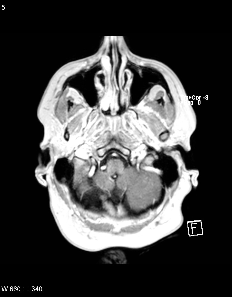 Astroblastoma (Radiopaedia 39792-42218 Axial T1 C+ 4).jpg