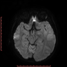 Astroblastoma (Radiopaedia 74287-85162 Axial DWI 40).jpg