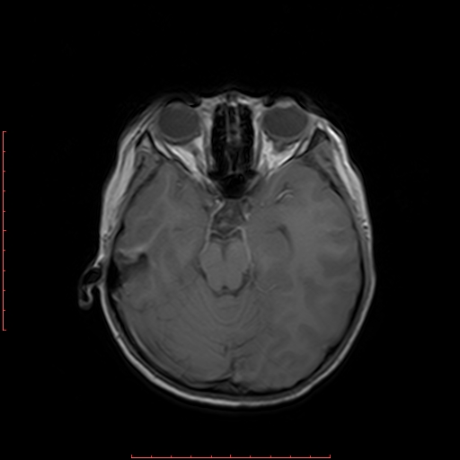 File:Astroblastoma (Radiopaedia 74287-85162 Axial T1 7).jpg
