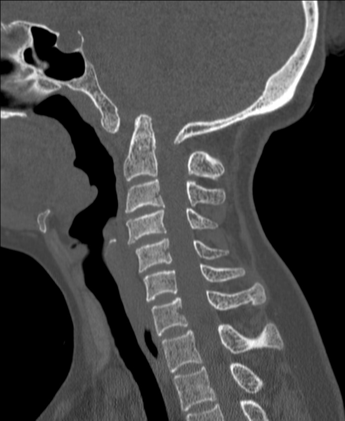Atlanto-occipital assimilation with basilar invagination (Radiopaedia 70122-80188 Sagittal bone window 62).jpg