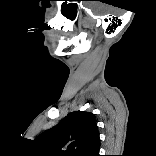File:Atlanto-occipital dissociation (Traynelis type 1), C2 teardrop fracture, C6-7 facet joint dislocation (Radiopaedia 87655-104061 D 20).jpg