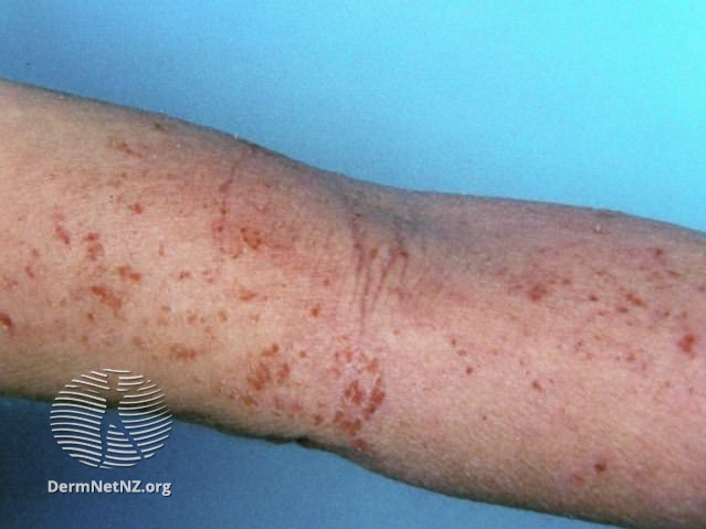 File:Atopic dermatitis (DermNet NZ dermatitis-flexural-eczema15).jpg