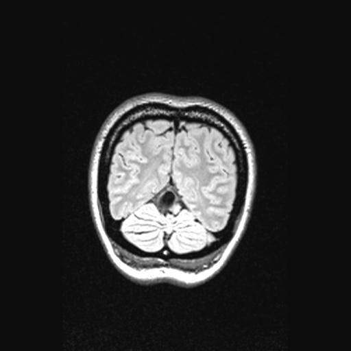 Atretic encephalocoele with inferior vermis hypoplasia (Radiopaedia 30443-31108 Coronal FLAIR 32).jpg
