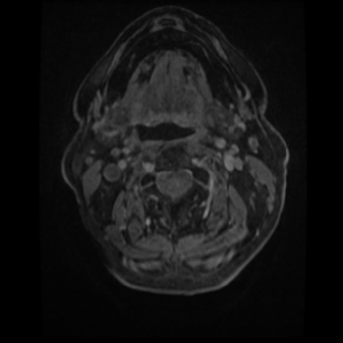 Atypical meningioma (Radiopaedia 45535-49629 Axial T1 C+ 2).jpg