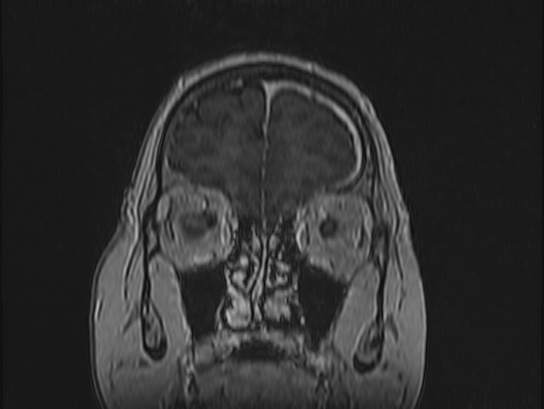 Atypical meningioma (Radiopaedia 62985-71406 Coronal T1 C+ 15).jpg