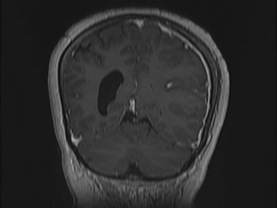 File:Atypical meningioma (Radiopaedia 62985-71406 Coronal T1 C+ 97).jpg