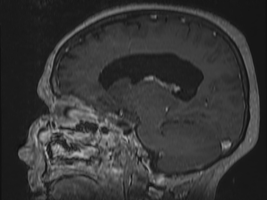Atypical meningioma (Radiopaedia 62985-71406 Sagittal T1 C+ 34).jpg