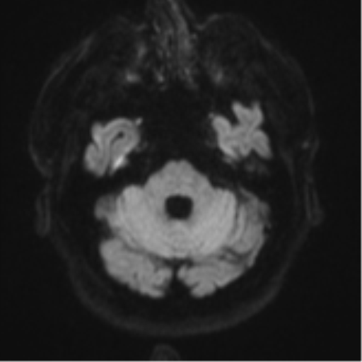 File:Atypical meningioma (WHO grade II) with brain invasion (Radiopaedia 57767-64729 Axial DWI 38).png