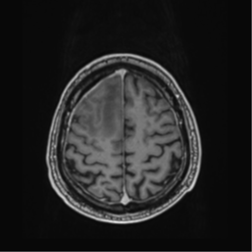 File:Atypical meningioma (WHO grade II) with brain invasion (Radiopaedia 57767-64729 Axial T1 C+ 40).png