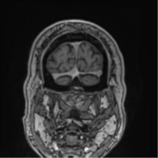 Atypical meningioma (WHO grade II) with brain invasion (Radiopaedia 57767-64729 Coronal T1 C+ 78).png