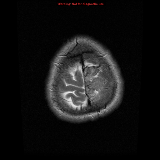 File:Atypical meningioma - grade II (Radiopaedia 13303-13305 Axial T2 21).jpg