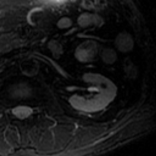 File:Atypical renal cyst on MRI (Radiopaedia 17349-17046 Axial T2 fat sat 13).jpg