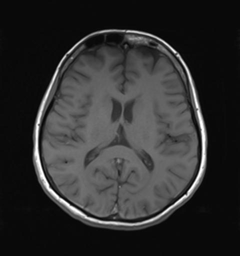 File:Autoimmune limbic encephalitis (Radiopaedia 30363-31005 Axial T1 19).jpg