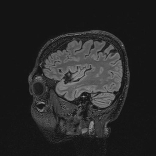 Autoimmune limbic encephalitis (Radiopaedia 30363-31005 Sagittal FLAIR 42).jpg