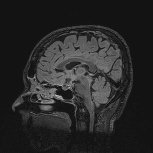 Autoimmune limbic encephalitis (Radiopaedia 30363-31005 Sagittal FLAIR 83).jpg