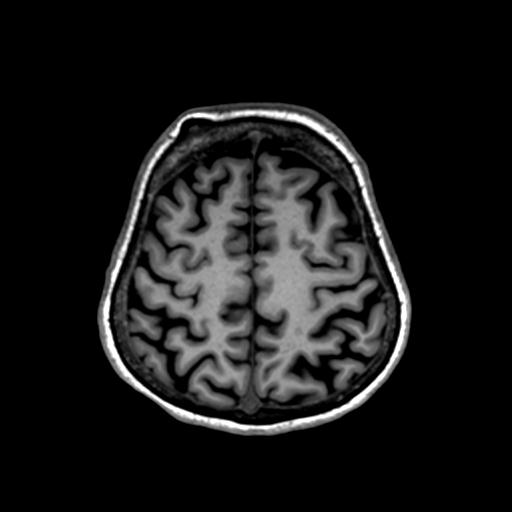 Autoimmune limbic encephalitis (Radiopaedia 30363-31005 T1 Axial 1mm 119).jpg