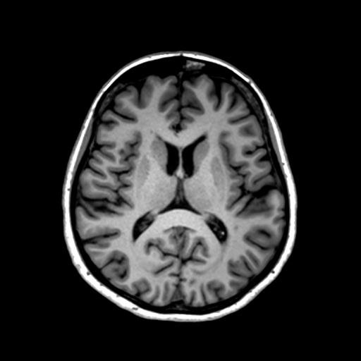 Autoimmune limbic encephalitis (Radiopaedia 30363-31005 T1 Axial 1mm 86).jpg