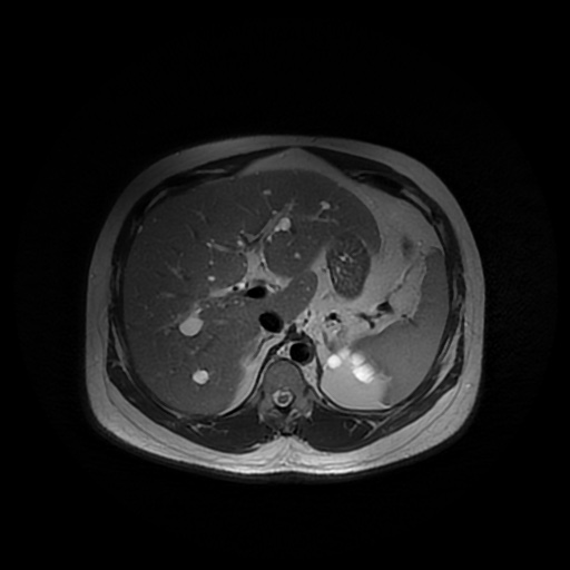 File:Autosomal dominant polycystic kidney disease (Radiopaedia 50259-55611 Axial T2 13).jpg
