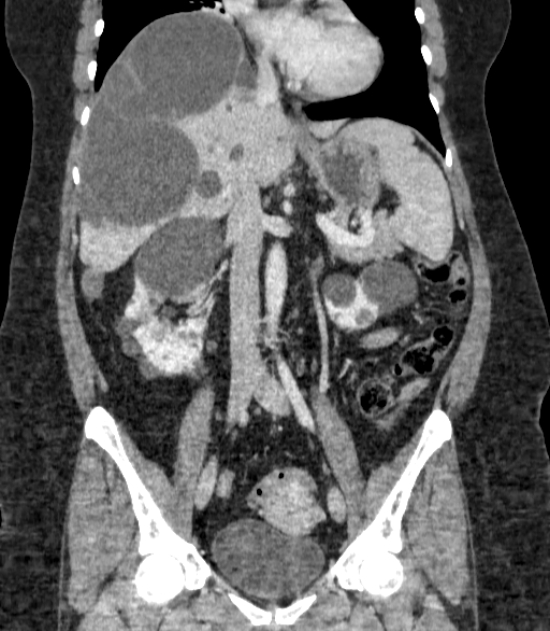 Autosomal dominant polycystic kidney disease (Radiopaedia 57124-64017 B 40).jpg