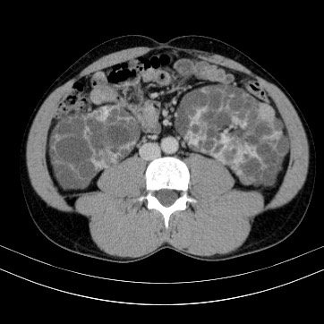 Autosomal dominant polycystic kidney disease (Radiopaedia 66349-75582 B 59).jpg