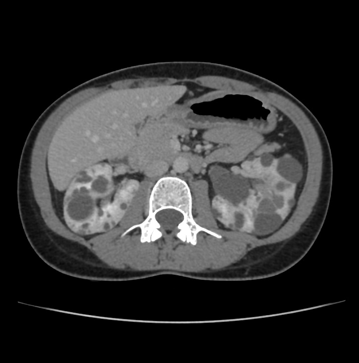 Autosomal dominant polycystic kidney disease - early onset (Radiopaedia 40734-43387 A 31).jpg