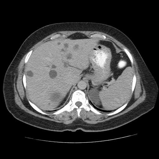 Autosomal dominant polycystic kidney disease with hepatic involvement (Radiopaedia 32693-33662 C 14).jpg
