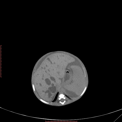 Autosomal recessive polycystic kidney disease associated with Caroli disease (Radiopaedia 61932-69984 Axial non-contrast 129).jpg