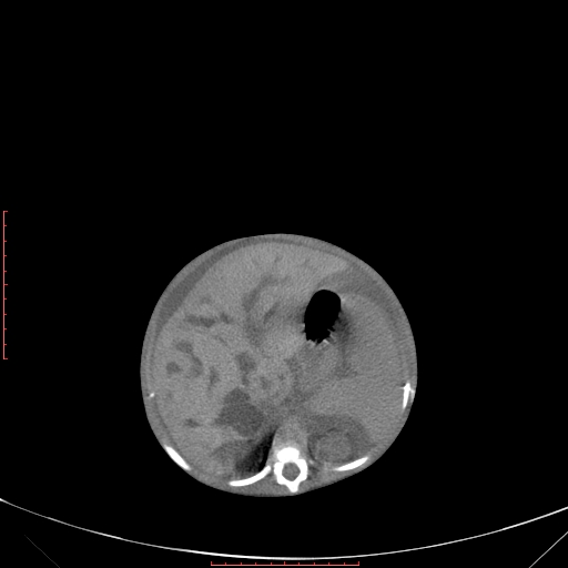 Autosomal recessive polycystic kidney disease associated with Caroli disease (Radiopaedia 61932-69984 B 140).jpg