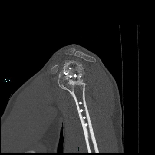 Avascular necrosis after fracture dislocations of the proximal humerus (Radiopaedia 88078-104655 Sagittal bone window 23).jpg