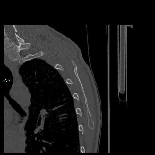 Avascular necrosis after fracture dislocations of the proximal humerus (Radiopaedia 88078-104655 Sagittal bone window 85).jpg