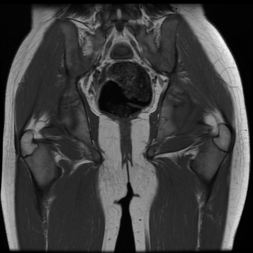 File:Avascular necrosis of the hip (Radiopaedia 29563-30067 Coronal T1 12).jpg