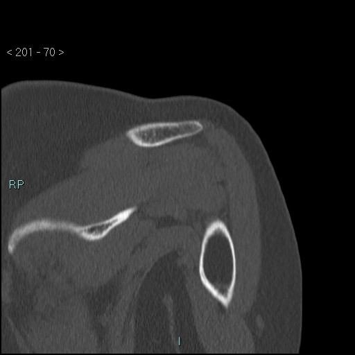 Avascular necrosis of the shoulder - Cruess stage I (Radiopaedia 77674-89887 Coronal bone window 69).jpg