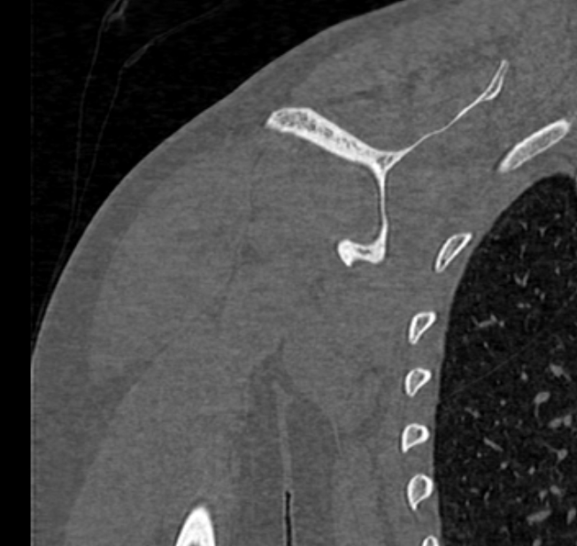 Avulsion fracture - greater tuberosity of humerus (Radiopaedia 71216-81514 Coronal bone window 53).jpg