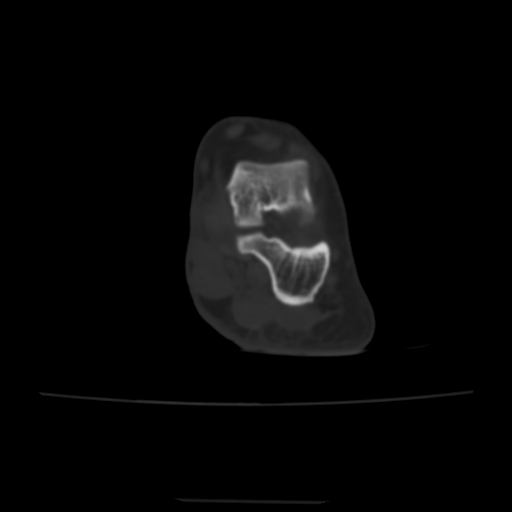 Avulsion fracture of the dorsal cuboid bone (Radiopaedia 51586-57377 Axial bone window 40).jpg