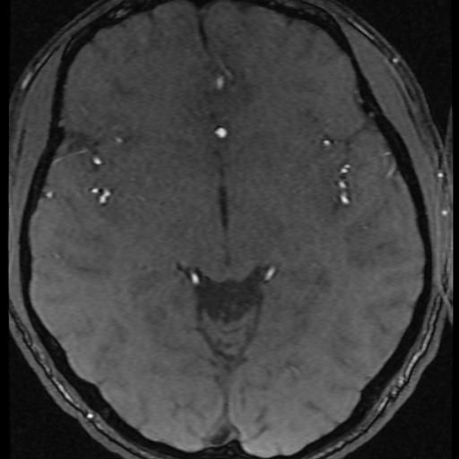 Azygos anterior cerebral artery (Radiopaedia 17059-16756 Axial MRA 25).jpg